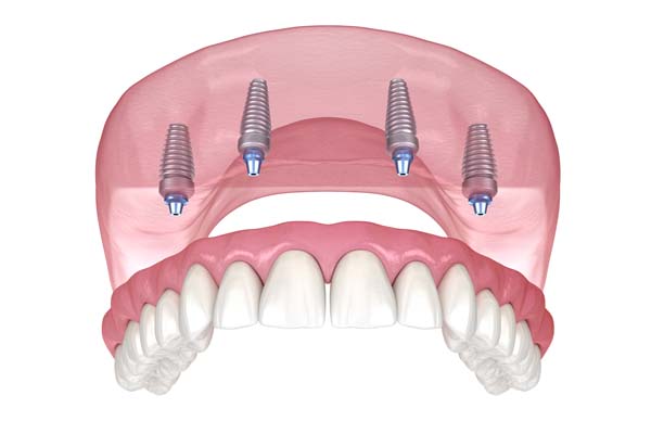 Reasons To Consider All On  ® To Replace Missing Teeth