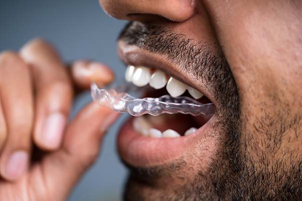 Benefits Of Choosing Clear Aligners