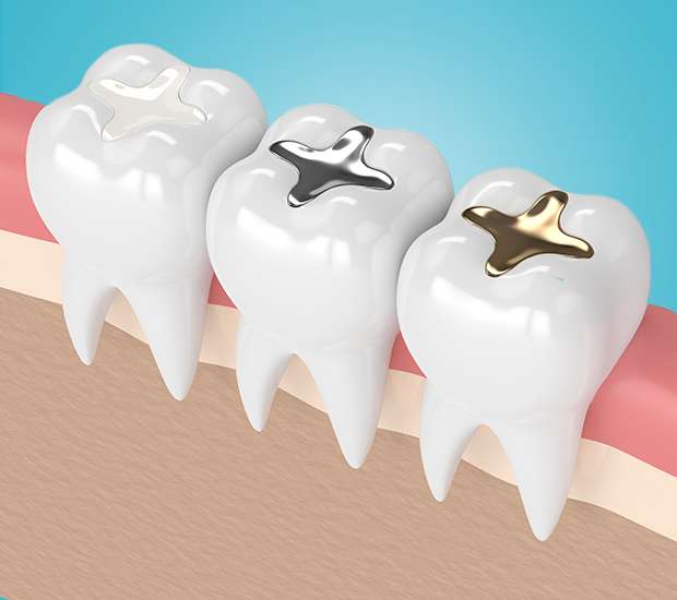 Forest Hills Composite Fillings