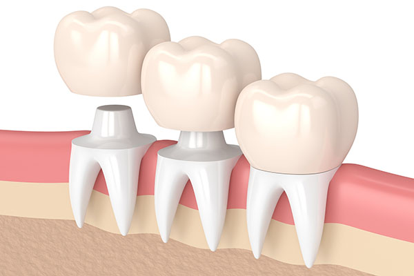 Three Tips to Deal With a Loose Dental Crown from Gentle Touch Dental Care in Forest Hills, NY