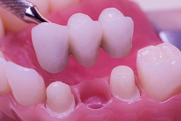 Are There Different Types Of Dental Bridge?