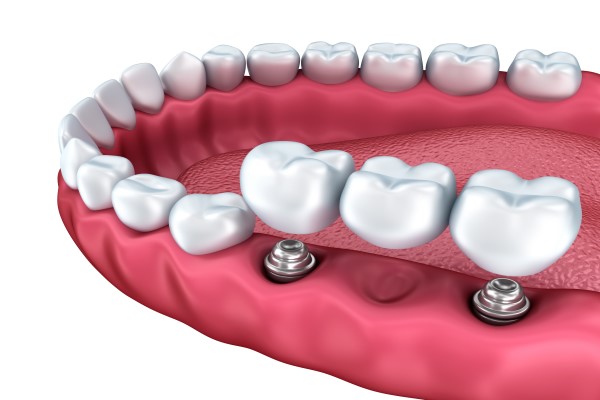 Pros And Cons Of Dental Bridges