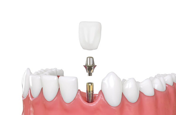 Getting A Dental Implant For A Missing Tooth