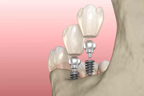 Avoiding Infection With Dental Implants