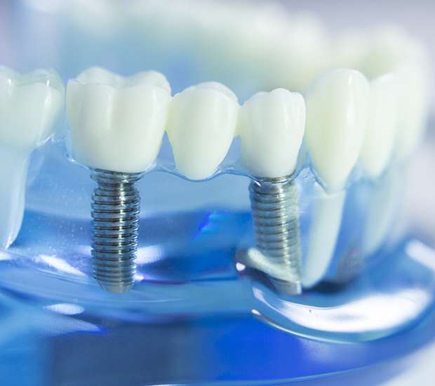 Forest Hills Dental Implants