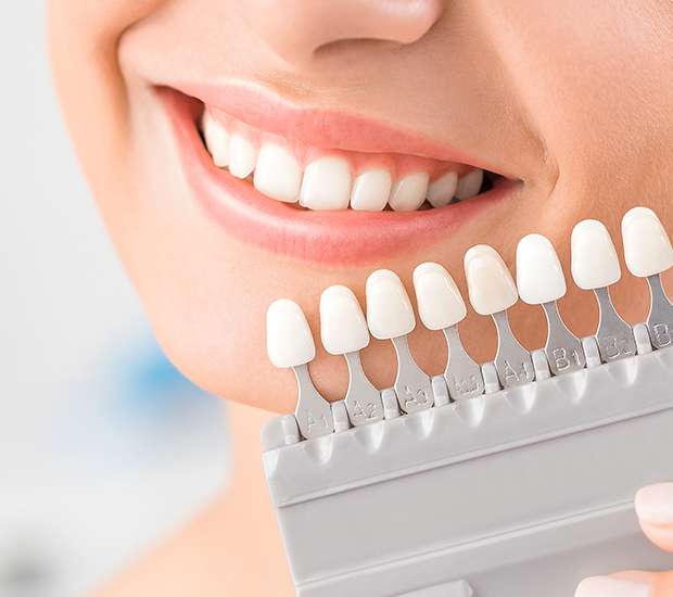 Forest Hills Dental Veneers and Dental Laminates