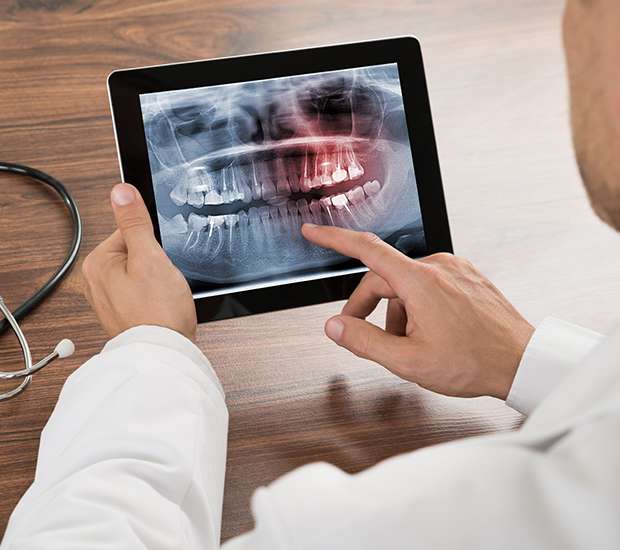 Forest Hills Types of Dental Root Fractures
