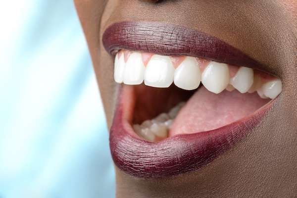 Routine Dental Care: What Are Tooth Colored Fillings from Gentle Touch Dental Care in Forest Hills, NY