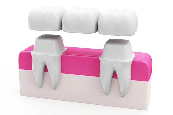 Why Choose a Bridge Option to Replace Missing Teeth from Gentle Touch Dental Care in Forest Hills, NY